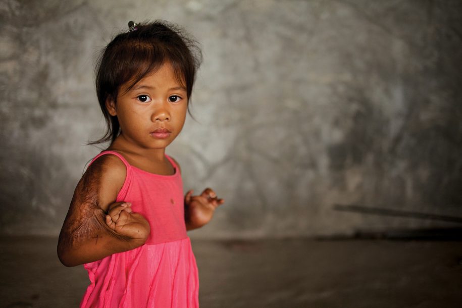 Jocy_before_surgery_at_the_Tebow_CURE_Hospital